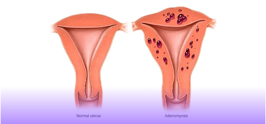 Menstrual disorders & Pelvic Pain by   Dr. Nikhila Reddy